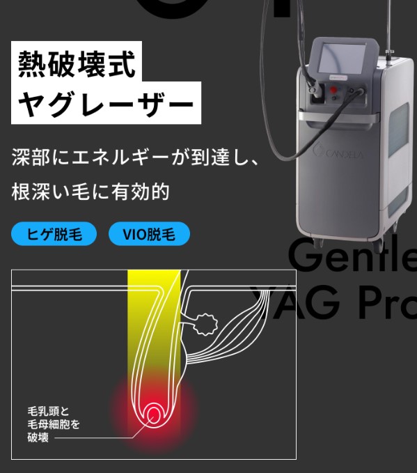 メンズリゼ脱毛機①ジェントルヤグ